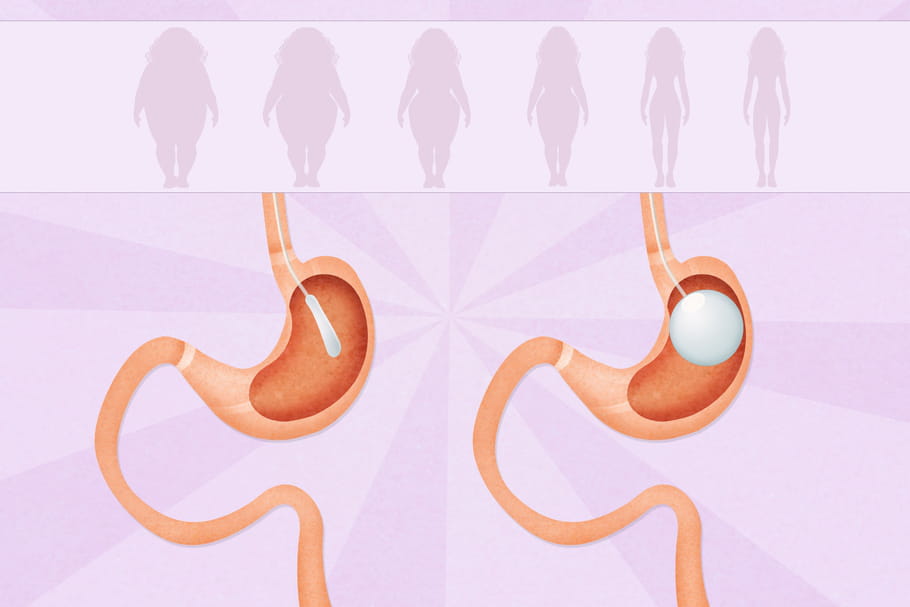 Ballon gastrique : c'est quoi, prix, IMC, combien de kilos perdus ?
