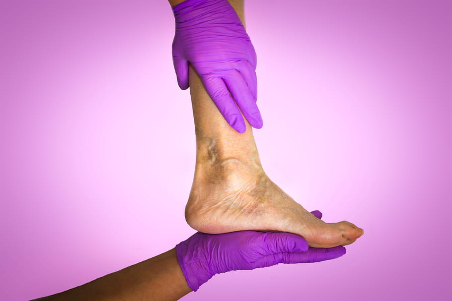 Mauvaise circulation sanguine : signes typiques et solutions