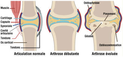 schéma de l'évolution de l'arthrose.