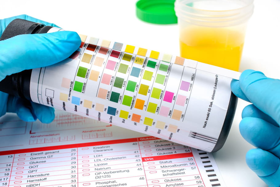 pH urinaire : normal, acide, alcalin comment le mesurer ?