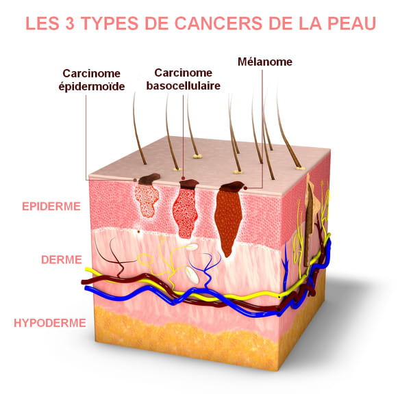 Dermatologue Cancer De La Peau Cancer De La Peau Sympt mes Images QNAG Dermatologue Cancer De La Peau Cancer De La Peau Sympt mes Images QNAG