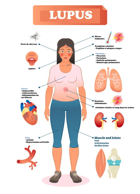 Symptômes d'un lupus