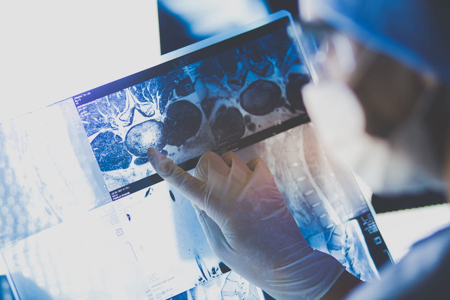 Stades du cancer : 1,2,3,4, comment savoir ?