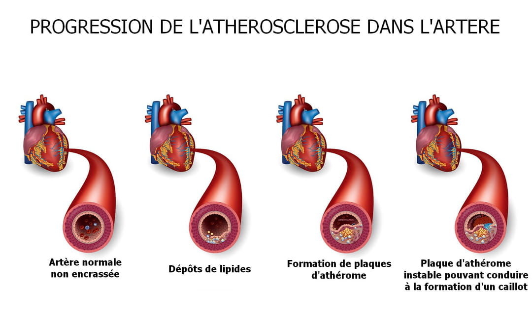 Ath roscl rose D finition Traitement Cons quences