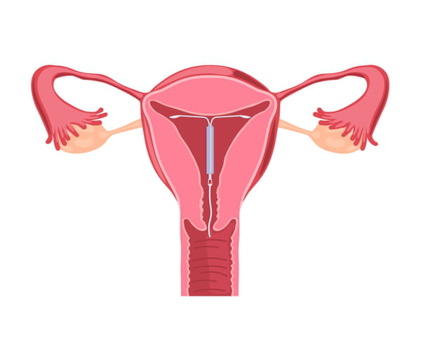 Stérilet dans l'utérus