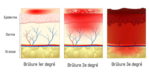 Schéma des degrés de brûlures de la peau