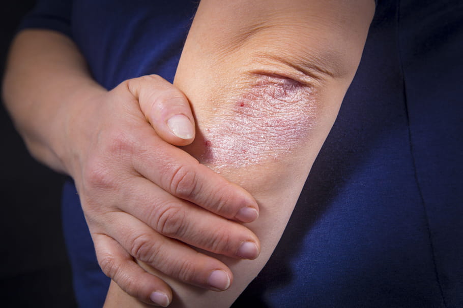 Psoriasis inversé : causes, symptômes, photo, traitement