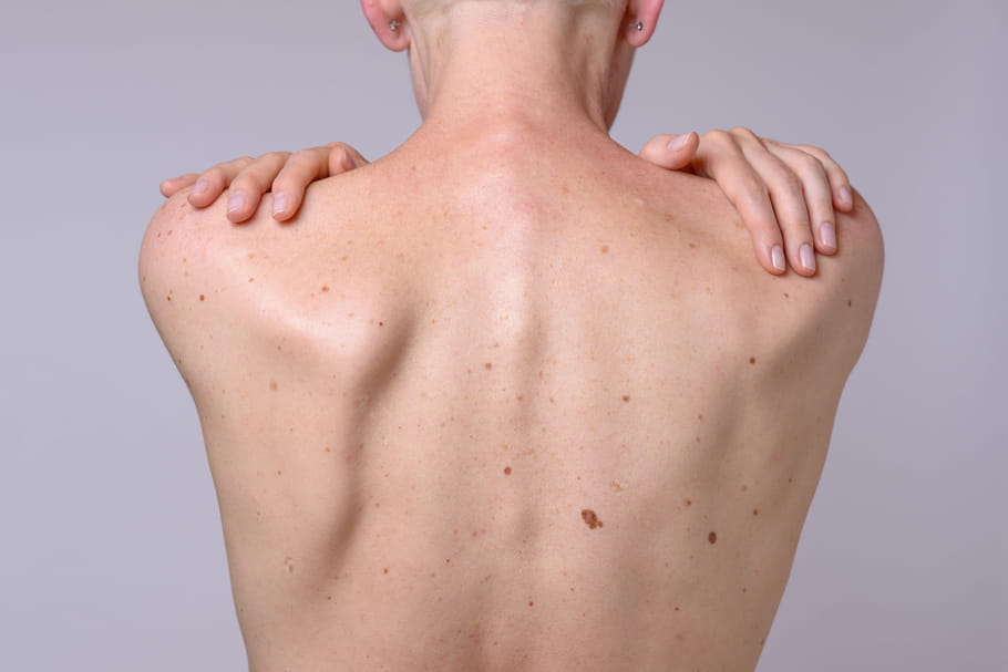 Carcinome spinocellulaire : traitements, aspect, âge, évolution