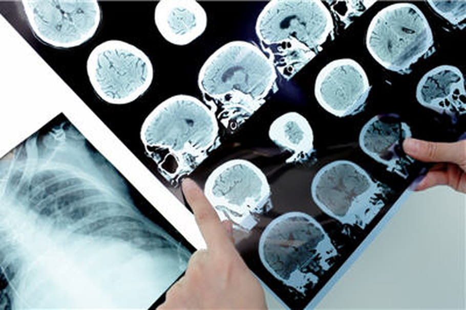 Alzheimer, Parkinson, SEP... Que contient le nouveau plan ?
