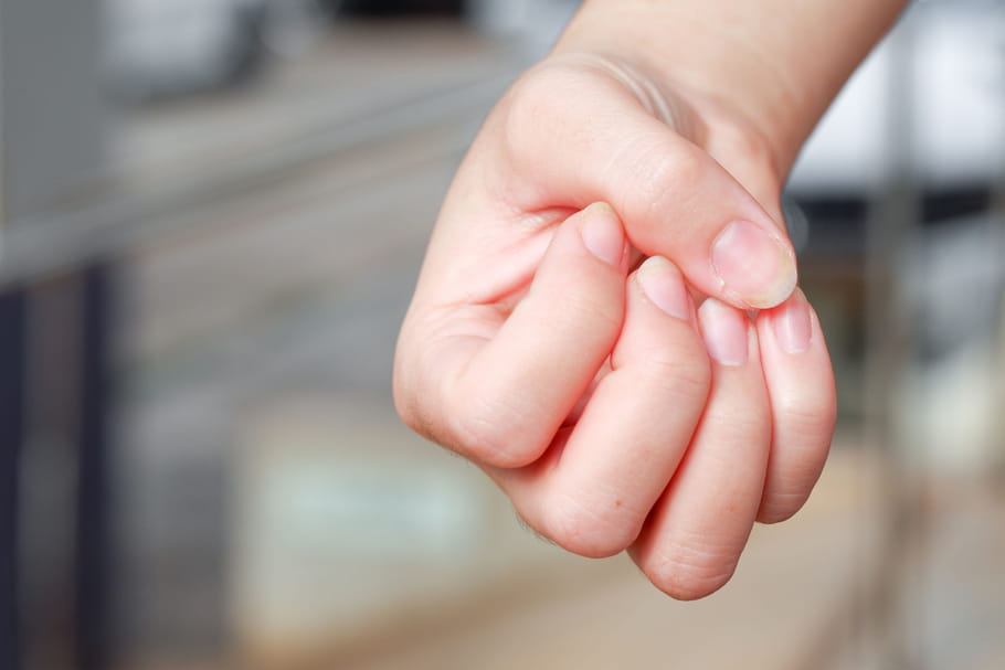 Psoriasis aux ongles : traitement, vernis, est-ce contagieux ?