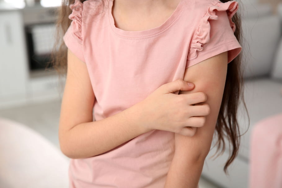 Psoriasis chez l'enfant : âge, aspect, cause, traitements