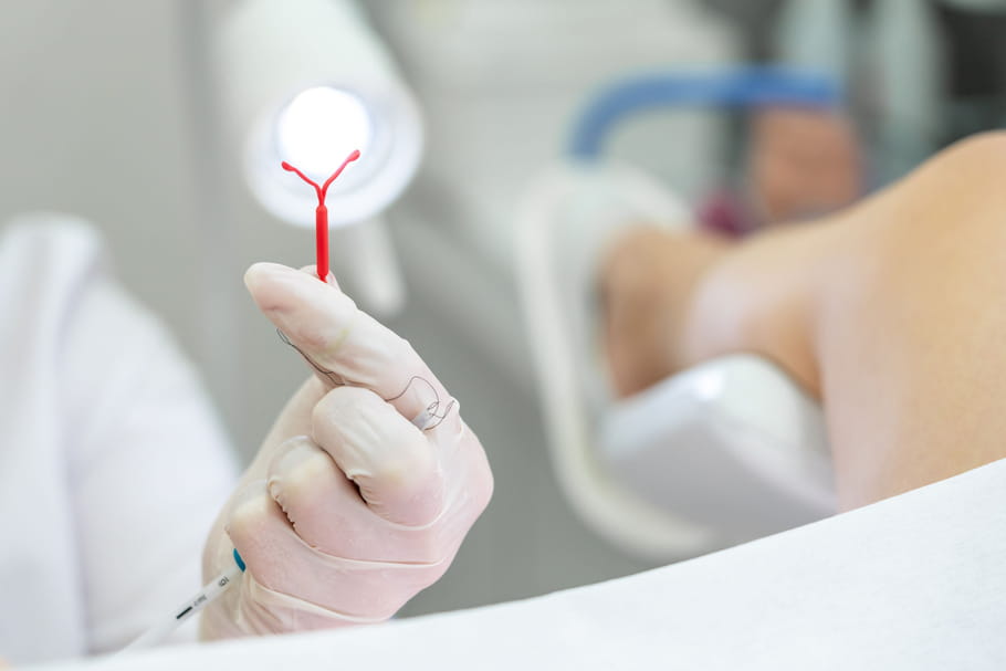 Tomber enceinte sous stérilet : hormonal, cuivre, symptômes