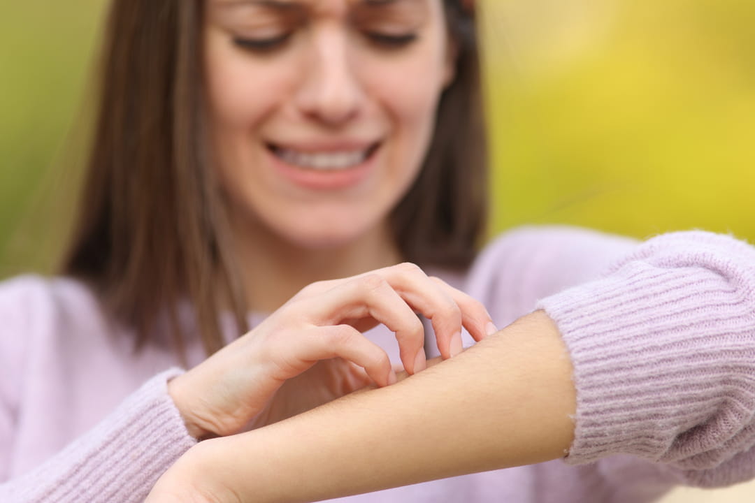 Insect bites buttons: What animals stung me?
