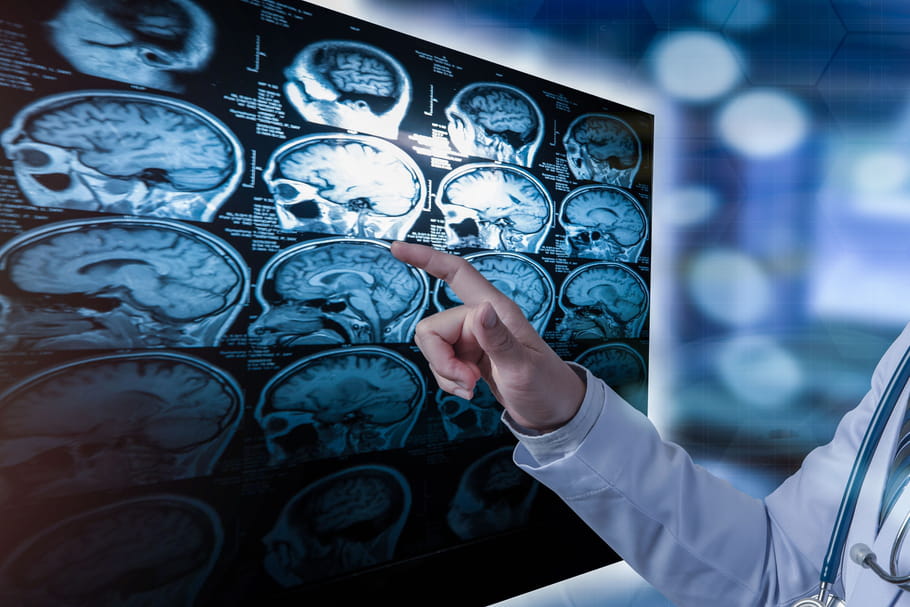 Méningiome : symptômes, biopsie, opération, traitements
