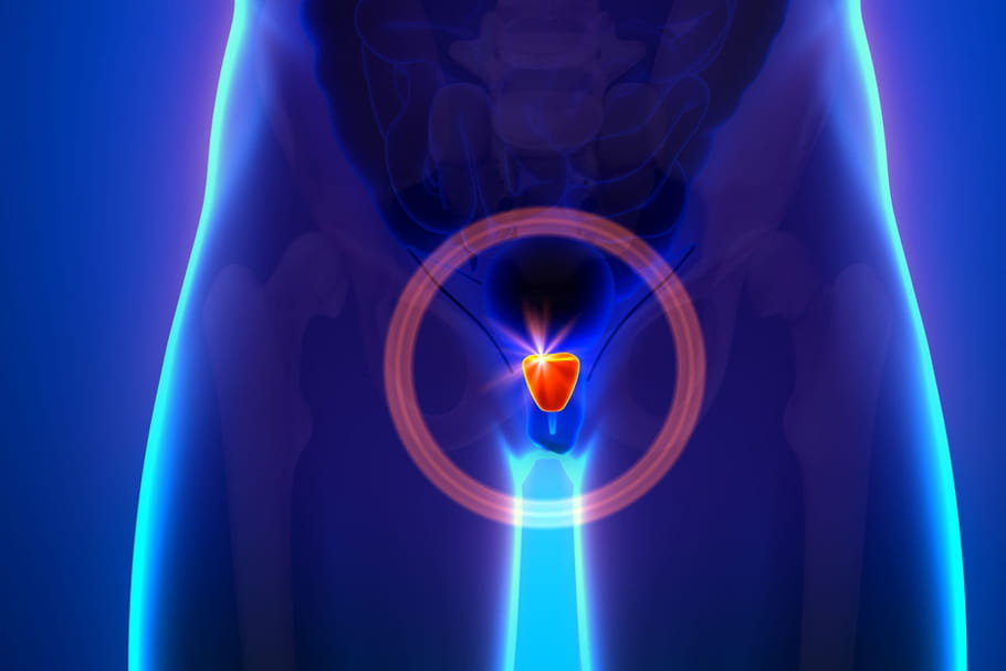 Dépistage du cancer de la prostate : comment le faire ?