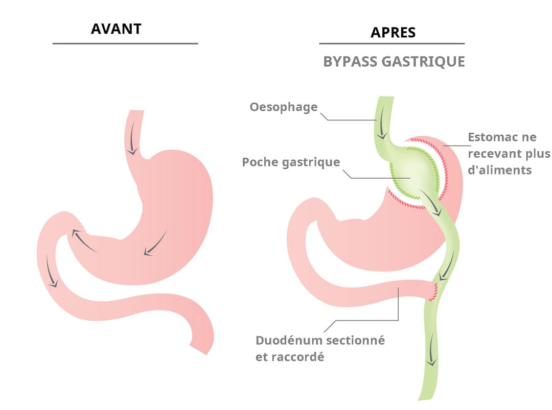 Bypass En Quoi Consiste L op ration en Y Ou En Om ga Bypass En Quoi Consiste L op ration en Y Ou En Om ga