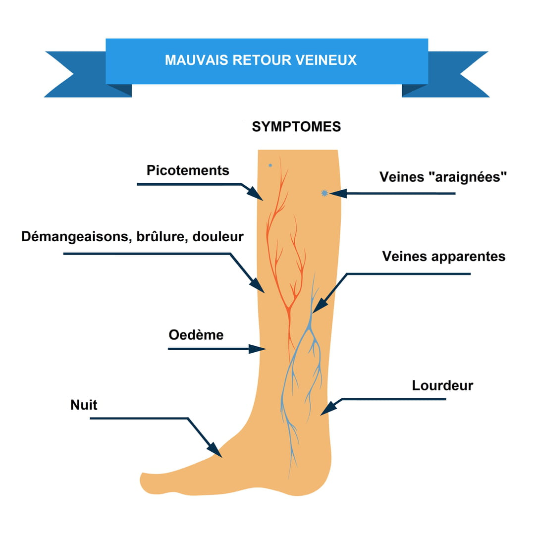 Taches Jambes Insuffisance Veineuse At Robert Lindsay Blog Taches Jambes Insuffisance Veineuse At Robert Lindsay Blog