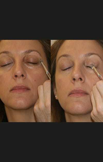 Comment cacher les rougeurs du visage&nbsp;: l'anti-cernes