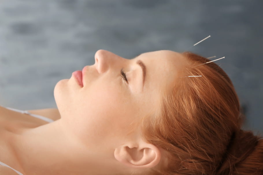 Acupuncture pendant la grossesse : est-ce efficace ?