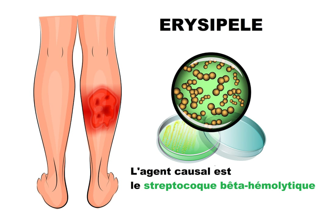  rysip le D finition Sympt mes Diagnostic Et Traitements UBQGGK