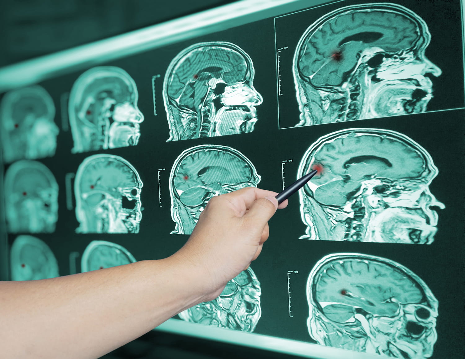 The risk of stroke falls when we walk this number of steps per day, especially after 60 years