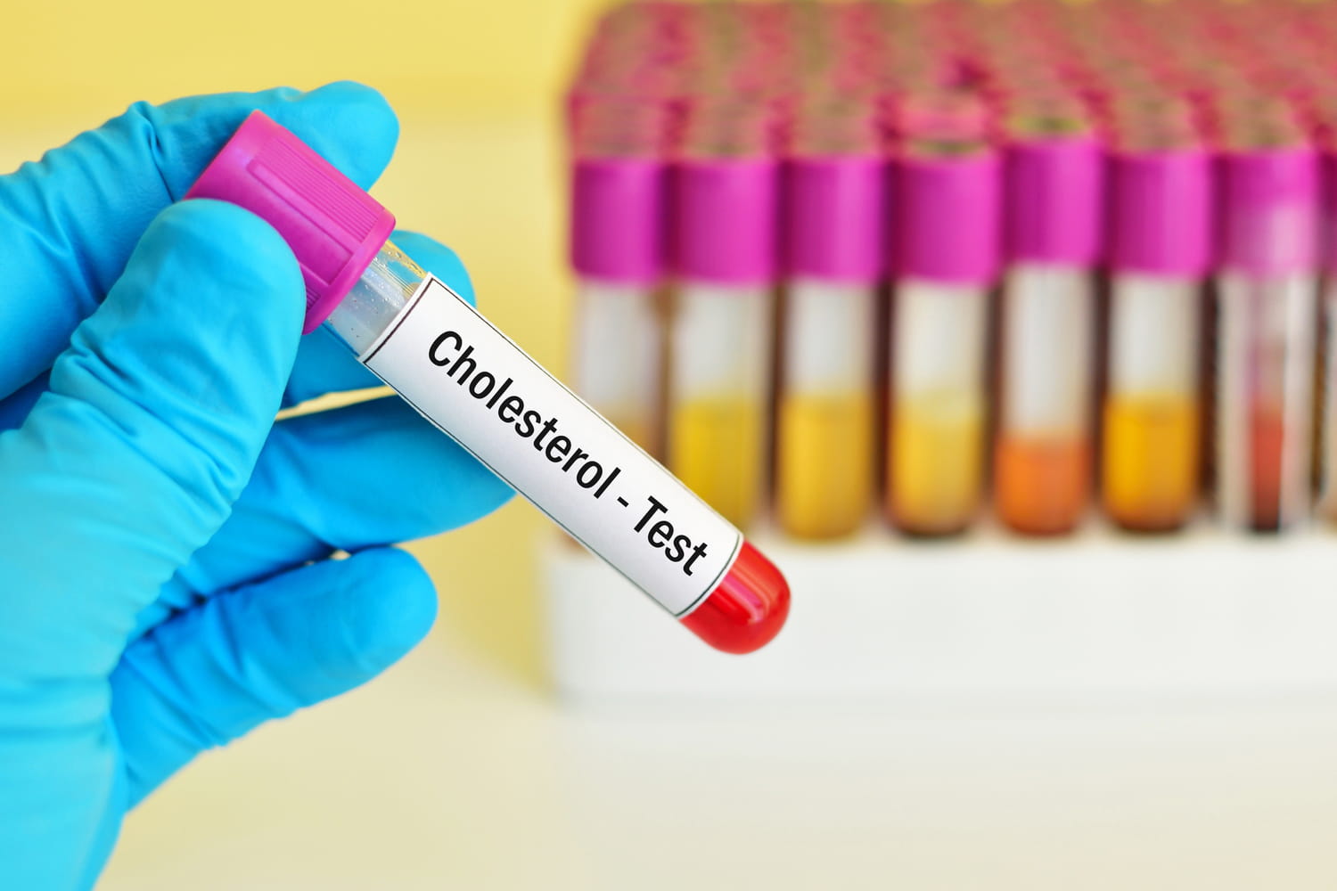 Here is the rate of cholesterol to never exceed after 70 years, according to a heart surgeon