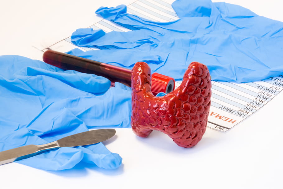 Thyroïde : chirurgie ou iode ?