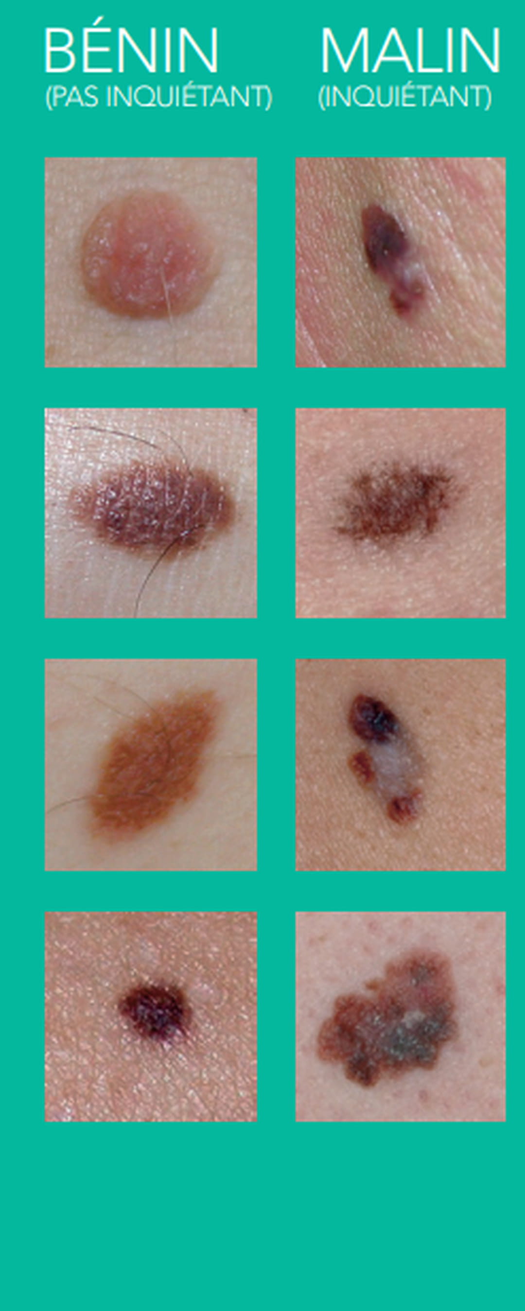 6 Signes D alerte D un Cancer De La Peau 6 Signes D alerte D un Cancer De La Peau