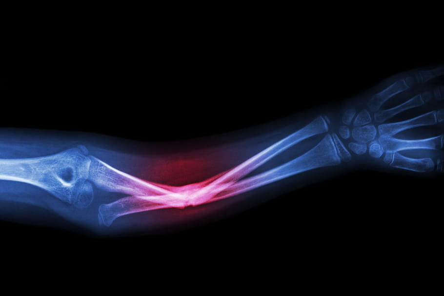 Lésion osseuse : causes, traumatisme ou signe d'un cancer des os ?