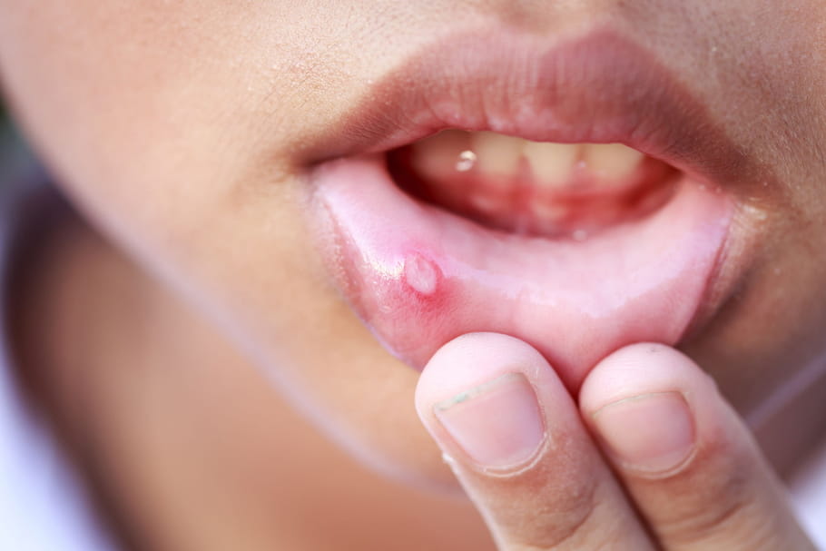 Herpès de l'enfant : tout savoir sur la gingivostomatite herpétique