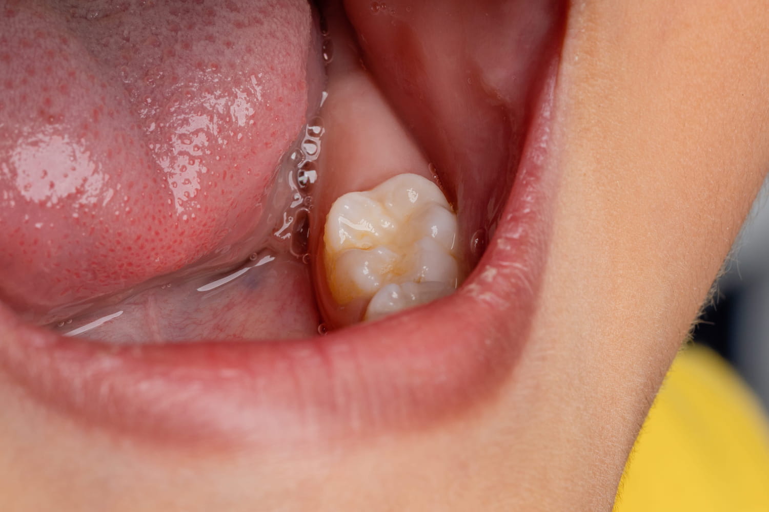 how do you know if you should remove them? how do you know if you should remove them?